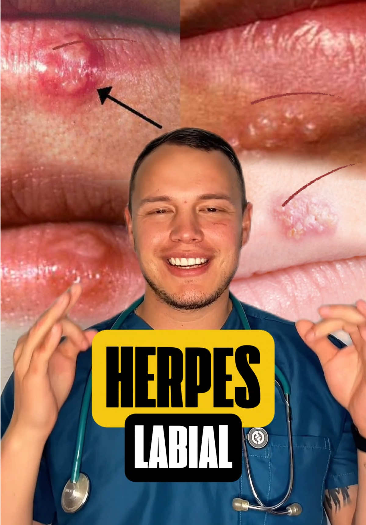 💋No has besado a nadie y aún así te sale ? 🤔 ¡Es herpes labial! 🚨 Causado por el virus HSV-1 🦠, aparece cuando tus defensas bajan ⬇️🤒.  ¿Cómo se contagia?  ✔ Contacto directo (besos, cubiertos, labiales) 👄🍽💄  ✔ Compartir vasos/toallas 🚫🥤  ✔ Estrés, sol ☀️ o cambios de clima ❄️🔥  🔝 ¡Protégete con estos tips!  ✅ Evita contagiar: No compartas objetos personales.  ✅ Refuerza tu sistema inmune: Vitamina C, zinc 🍊💊  ✅ Usa protector labial con SPF ☀️👄  ✅ Aplica crema antiviral al primer síntoma (hormigueo, picor).  ⚠️ Si YA lo tienes:  ✖️ No lo toques (¡empeora! 👆❌)  ✖️ Evita besos y contacto cercano 💋🚫  ✖️ Usa parches invisibles para protegerlo 🔍  ¡Cuida tu salud y comparte esta info! 💖✨  #SaludLabial #HerpesRemedios  ¿Te ha pasado? ¡Cuéntame en comentarios!👇😊