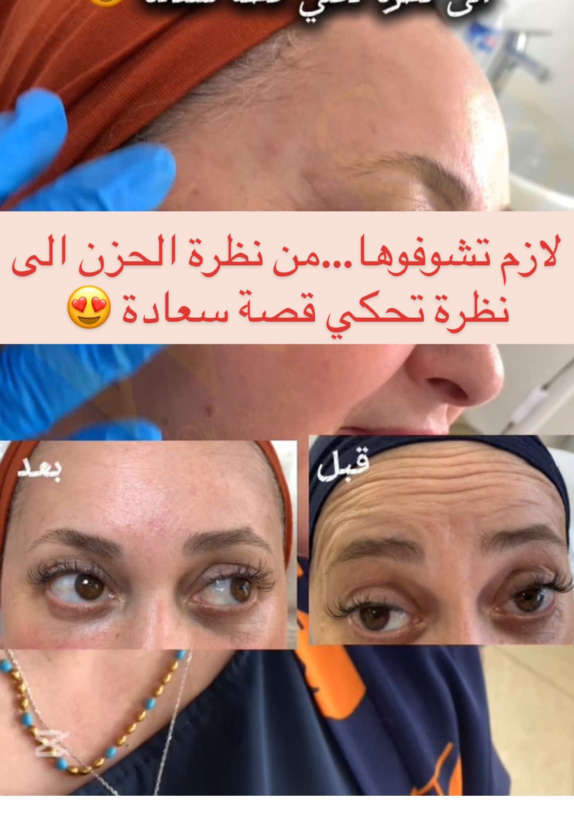Pour toutes prises de rendez-vous veuillez nous contacter via :  📞05.53.32.15.73 📞07.75.89.88.03 #wasa #wasa_clinic #ترهلات_الوجه #شدالوجه #effet_naturel #effet_lifting #texas #jawline #محفزات_الكولاجين #طبيعي #جمالك_سيدتي #صحتك #medical #جزائرية_وافتخر #ترهل #شد # #ترهلات_الرقبة #رقبة #بوتوكس #تجاعيد