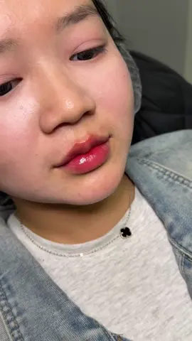 Nét nèn nẹt luôn 🤪🤪🤪#Filler #FillerCollagen #Tiêmfiller #CayHa #fullface #FillerCollagen #karisma #foryou 