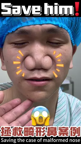 #鼻整形 #鼻综合 #鼻修复 #隆鼻 #鼻子 #隆鼻术 #nose #nosejob #rhinoplastie #nosejobs #帅哥 #rhinoplasty #handsomeman #handsomeguy #handsomeboy #handsome 