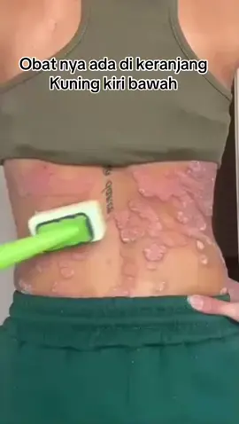 #rekomendasiobatgatal #obatgatal #belanjaditiktoklagi 