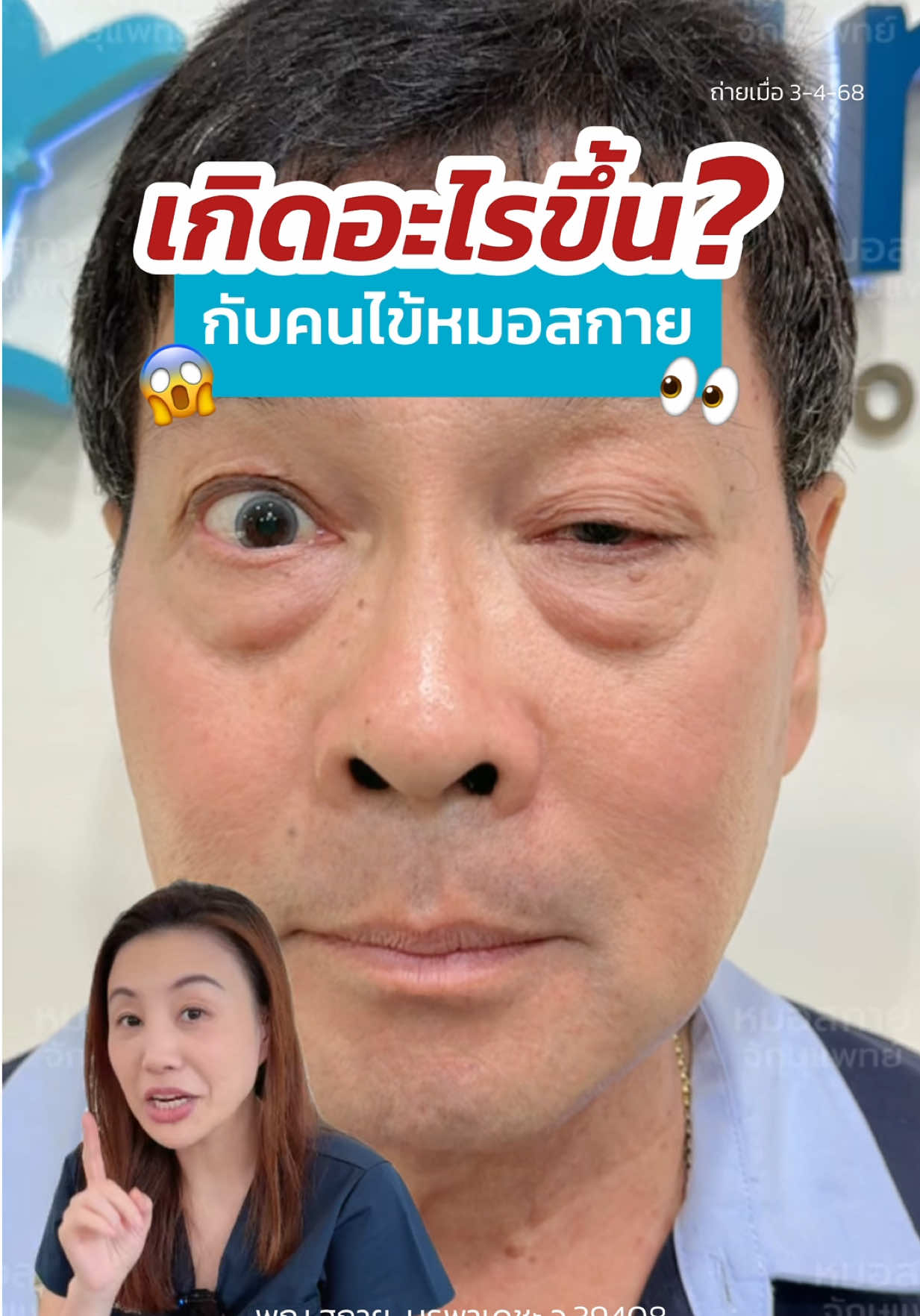 เกิดอะไรขึ้น? กับคนไข้หมอสกาย‼️ #หมอสกาย #จักษุแพทย์ #skyclinic #skyclinic_drsky  #ทำตาสองชั้น #โรคตาแปลก #กล้ามเนื้อตาอ่อนแรง