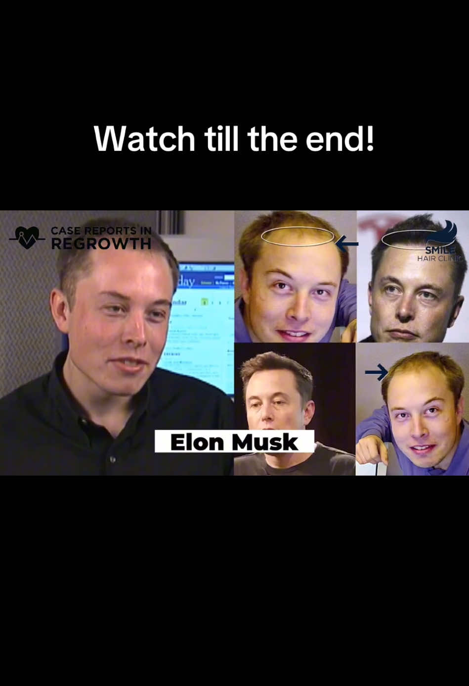 Elon Musk to David Bekham | Hair Regrowth Revolution #MuhammadQasim #hairgrowth #fyp #nhsuk 