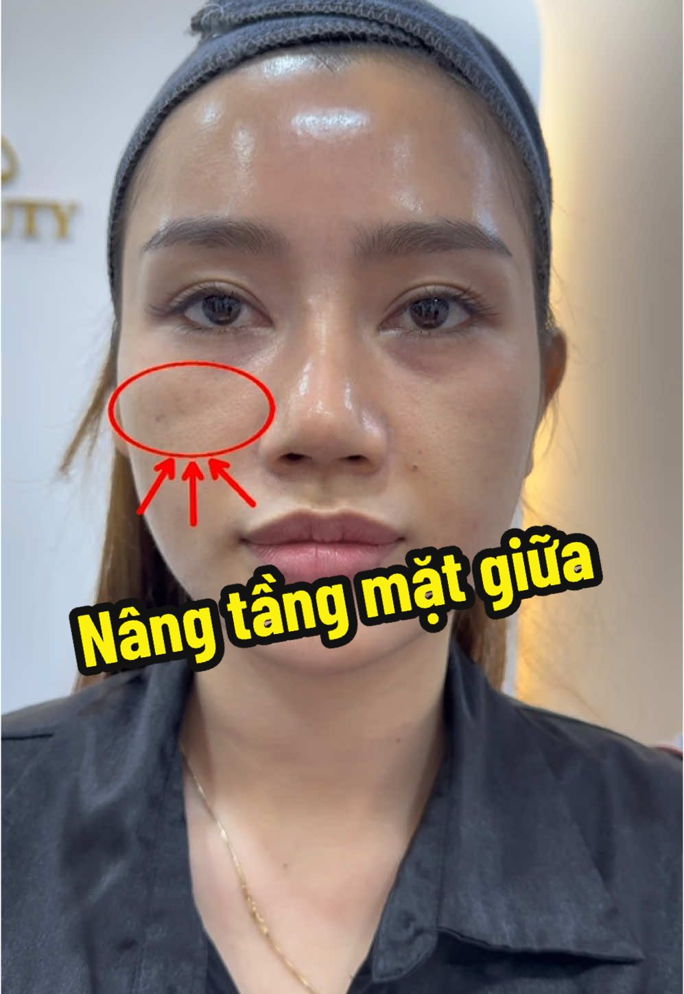 Nâng tầng mặt giữa bằng kỹ thuật MDcodes #bacsihakhotinh #mdcodes #nangtangmatgiua 