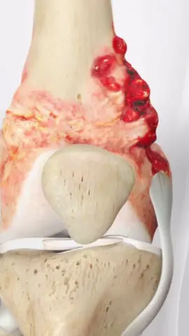 Osteosarcoma, also known as osteogenic sarcoma, is a rare, aggressive bone cancer that often develops in teenagers and young adults, with the most common sites being around the knee and shoulder joints. #youngadult #bonecancer #kneeandshoulder #sarcoma #medicaleducation #medicalanimation #3danimation #3dmedicaleducation #3danimationsurgery