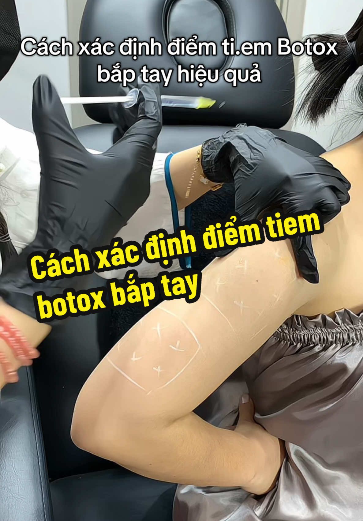 Cách tiem botox bắp tay hiệu quả 