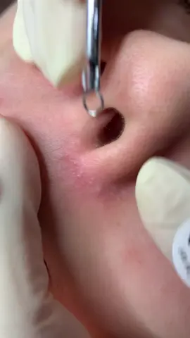 Ko đau #chamsocdamun#chamsocdaseo#chamsocdanam#tanbinh#govap #Lequynh #quynhle#lqspa #hocnghespa  #chamsocda #lequynhspa #vienthammylqspa#lqspabeautyacdemy #nanmunbangtay #nanmunbangtambong # nanmunbangcay