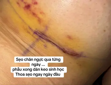 Ngắm chiếc sẹo chân ngực mỗi ngày là điều bà nào nâng c1 xong cũng làm 😊😊#nangnguc #lamdep #pttm #sẹo #v1 