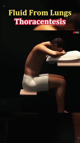 How Doctors Drain Fluid From Your Lungs (Life-Saving Procedure!) #lunghealth #medicalprocedures #doctorexplains #thoracentesis #LearnOnTikTok #healthtips #sciencesimplified #breatheeasy 