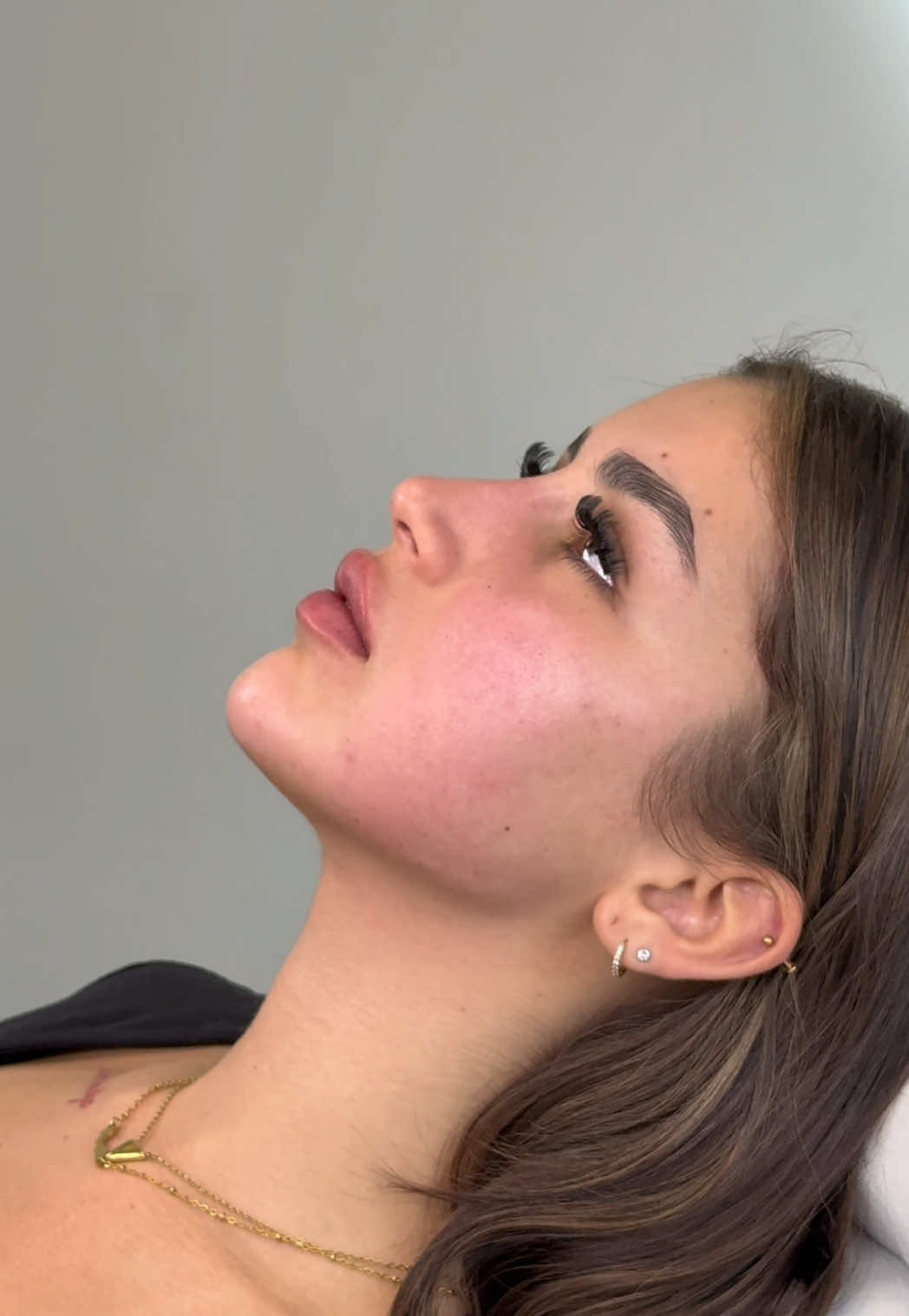 Harmonizing your features with a full face approach💉 Snatched, sculpted & subtle! #fullface #fullfacefiller #filler #fillers #lipfiller #lipfillers #lipaugmentation #nosefiller #nosefillers #chinfiller #chinfillers #cheekbones #jawline #injectables #fy #fyp #doktersnel #amsterdam 