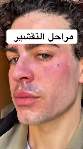 تقشير بارد يوم بيوم بدون فلاتر، بدون خرافات شوف بنفسك التغيير الحقيقي من التصبغات للنضارة في أسبوع #تقشير_بارد #peeling #سكين_كير #بشرة_صحية #قبل_وبعد #اسطنبول #istanbul 