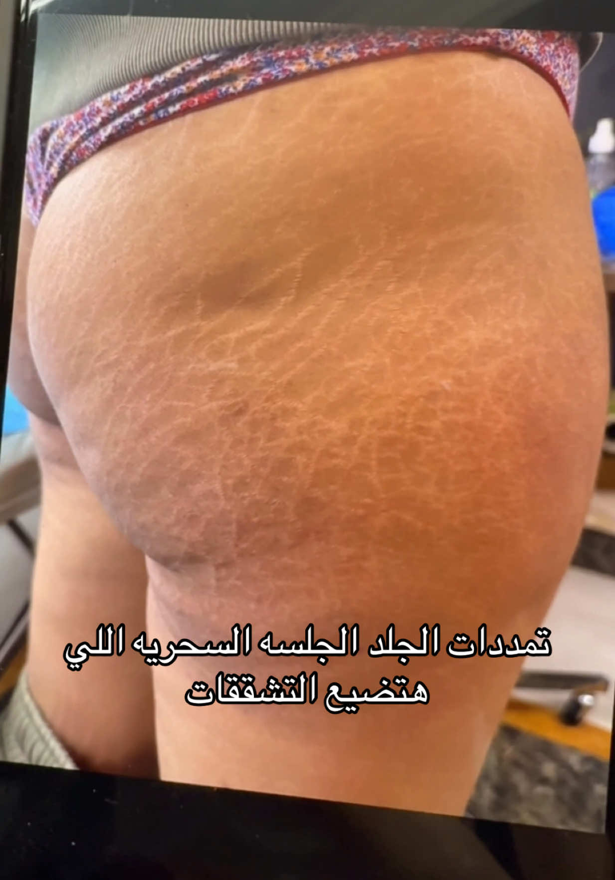 نتيجه جلسه اخفاء للتشققات #الخطوط_البيضاء_والحمراء  #علامات_التمدد #تشققات #تشققات_الجسم #stretchmarks #علامات_تمدد_الحمل #بنات_جده #بنات_السعوديه #بنات_الرياض #jeddah #saudiarabia #كاموفلاج #كاموفلاج_ستريتش_مارك #كاموفلاج_الرياض #fpyツ #fpy #الشعب_الصيني_ماله_حل😂😂 #اكسبلورexplore
