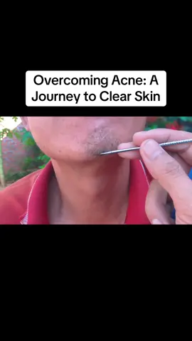 Overcoming Acne: A Journey to Clear Skin #acnejourney, #skincare, #SelfCare, #acnepositivity, #pimpletips #creatorsearchinsights 
