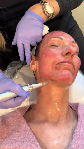 So relaxing and satisfying. I can watch this all day 😍 #microneedling 