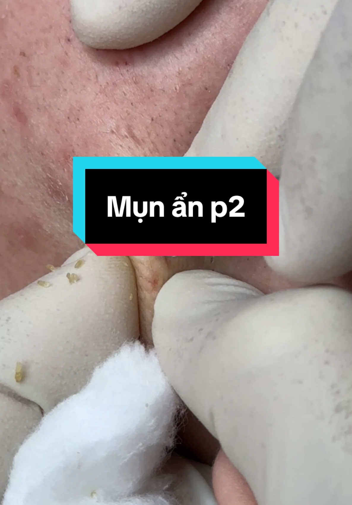 Mụn ẩn P2#winspavungtau #trimunvungtau #nanmunvungtau #nanmun #spavungtau #spauytinvungtau 