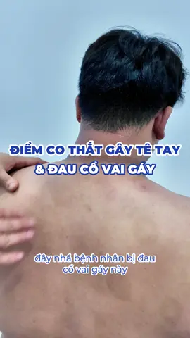 Giải tỏa điểm co thắt gây ra cơn đau cổ vai gáy trong suốt 1 năm #hocvientrilieusmed #yhoccotruyen #coxuongkhop #tetay #dathongkinhlac #bamhuyet #trilieucovaigay #daucovaigay #videoviral #fyp