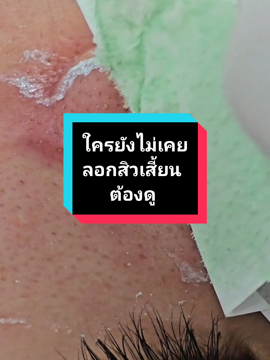 หลุดยันราก #ลอกสิวเสี้ยน #สิวเสี้ยน #สิว #ครีมลอกสิวเสี้ยน 