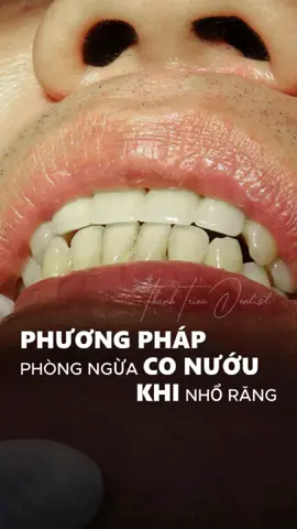 🦷💎 PHỤC HÌNH SỨ OVATE PONTIC – GIẢI PHÁP NGỪA CO NƯỚU SAU NHỔ RĂNG! 💎🦷 Bạn sắp nhổ răng❓ Lo lắng sau nhổ nướu bị co rút, lõm xuống, mất thẩm mỹ khi cười 😟? Đừng lo! ✨ Ovate Pontic chính là “vị cứu tinh” cho nụ cười của bạn! 🌟 👉 Đây là kỹ thuật phục hình sứ với phần nhịp thiết kế đặc biệt, ôm sát mô nướu, ✅ Tạo hình nướu đẹp chuẩn tự nhiên ✅ Phòng ngừa tụt nướu, lõm nướu sau nhổ răng ✅ Giữ dáng nướu ổn định để sẵn sàng trồng răng sau này ✅ Tăng tính thẩm mỹ – nụ cười vẫn rạng rỡ dù đang chờ làm răng thật! 😁🌸 💬 Được áp dụng phổ biến trong các trường hợp cần nhổ răng nhưng vẫn muốn đảm bảo tính thẩm mỹ cao 💯 🌿 Ovate Pontic – giữ vững dáng nướu, giữ trọn nụ cười! 💕 Inbox để được tư vấn chi tiết nhé! 📩📞#xh #fyp #lamdep #rangsuthammy #dansuveneer #implant #niengrang #taytrangrang #chamsocrangmieng #nhakhoathanhtrieu #nhakhoauytin #xuhuong #EnergiKuatTiapLangkah 