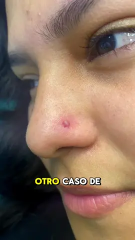 ¿Tienes un bulto al lado de tu piercing en la nariz? Podría ser un granuloma… pero no te preocupes, ¡tiene solución! En este video te enseño qué es, por qué aparece y cómo tratarlo correctamente para que tu nostril sane bonito y sin marcas. Consejos reales, fáciles y seguros desde la experiencia de un profesional. Guárdalo, compártelo y sígueme para más contenido sobre piercings. #GranulomaPiercing #PiercingNariz #PiercingNostril #CuidadoPiercing #PiercingConsejos #PiercingInfección #BodyPiercing #PiercerPerú #JJElChicoDeLosPiercing #SoluciónGranuloma #PiercingProblemas