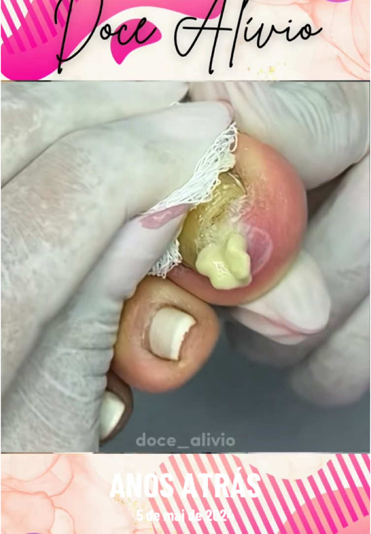 #anosatrás #toenails #toenail #ingrowntoenail #toenailremoval #nails #satisfying #foryou