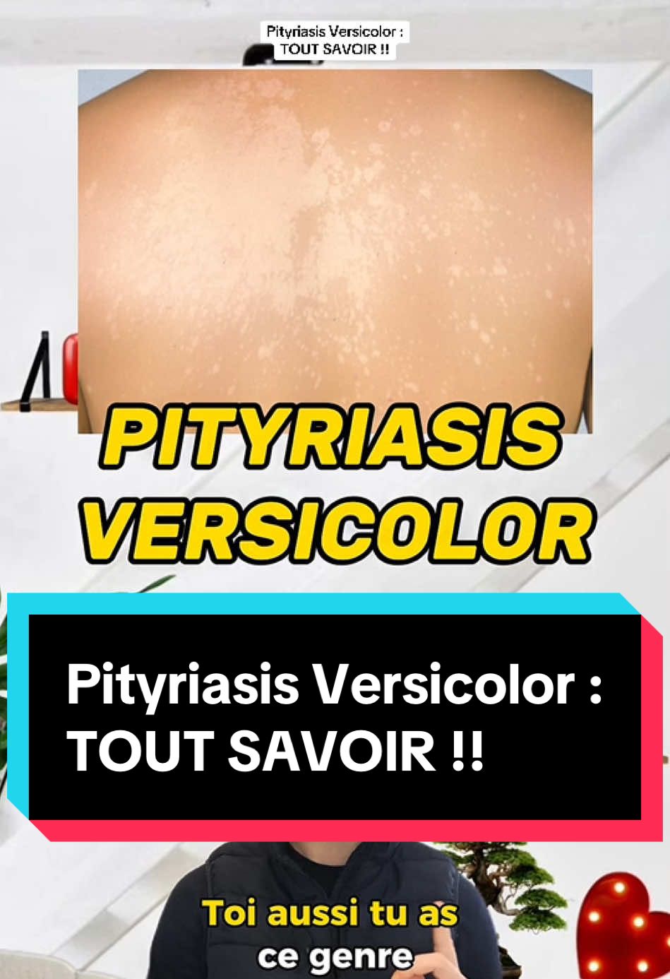 Pityriasis Versicolor : TOUT SAVOIR !! #tiktokacademie #sante #pityriasisversicolor #pityriasis #malassezia #tineaversicolor #mycose #peau #skin #dermatologist #medical #education #prevention 