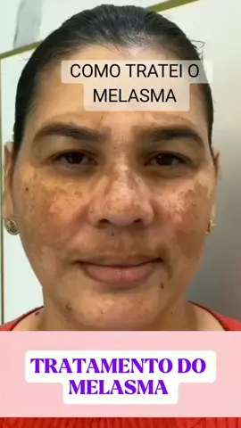 COMO TRATEI MEU MELASMA  #rosaamazonica #sérum  #pele #rejuvenescimento #rugas #melasma 
