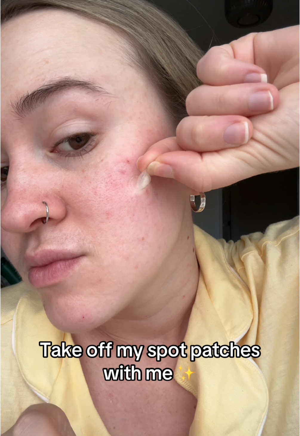 Your breakout bestie @Nicole | Life in my 20s🌷🎀 #pimpletok #pimplepatchresults #skinchoice #skinchoicepimplepatch 