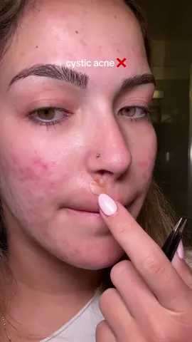 More satisfying pimple patch take off as requested! This one under my nose has been A PAINN! Luckily @PeaceOutSkincare acne dots came to the rescue! #fyp #acneskin #acne #pimplepopping #satisfying #skin #cysticacne 