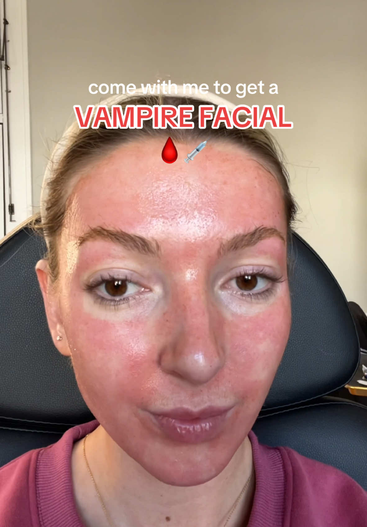 love a good vampire facial! So good for fine lines and boosting new skin growth 🩸💉 @Portrait @cassandra.injector.ARNP #vampirefacial #skintreatment #prp #antiagingskincare 