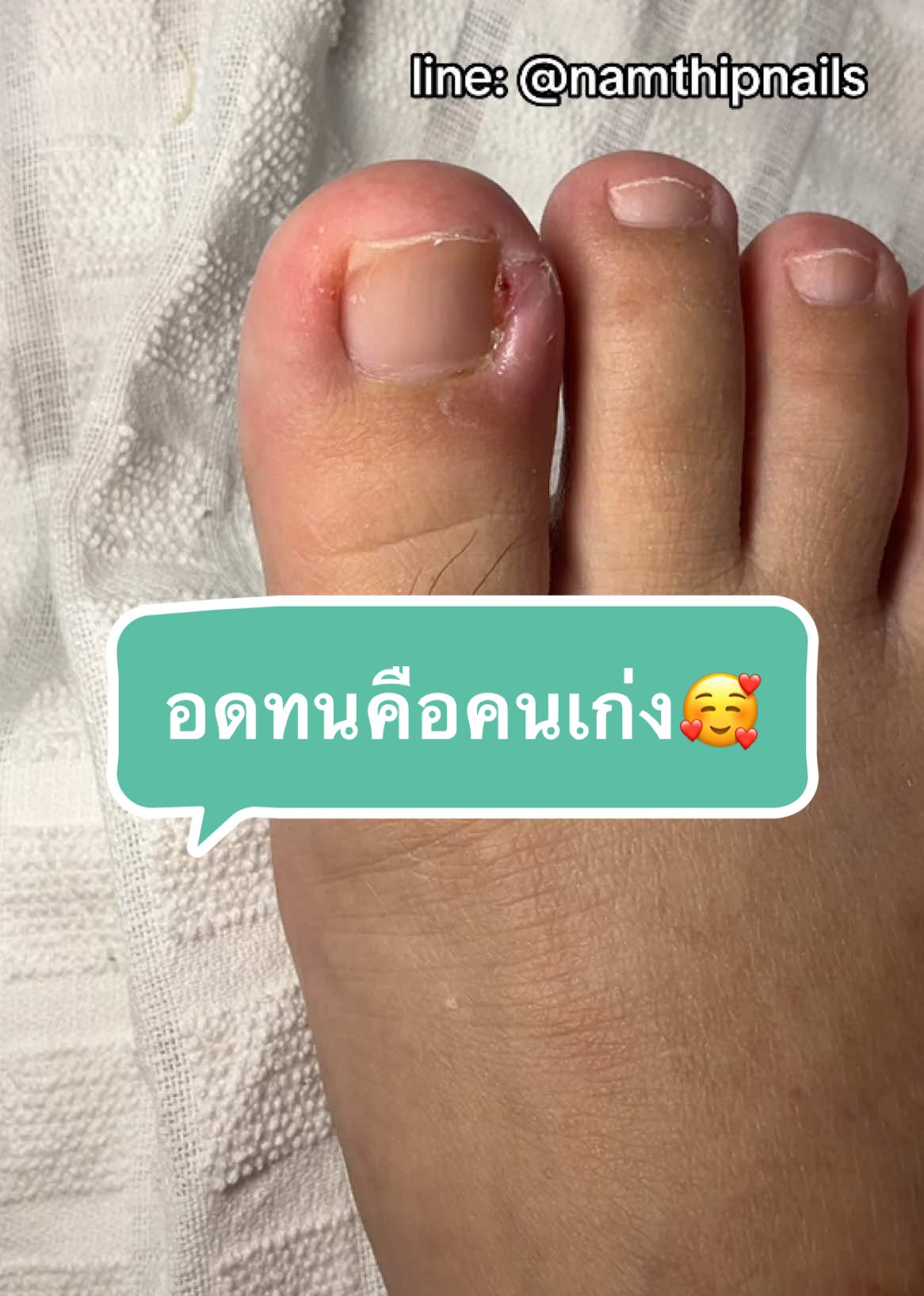 💓 #namthipnails #ตัดเล็บขบ #ตัดหนัง #ทำเล็บ #ร้านตัดเล็บขบ #ร้านตัดเล็บขบราม2 #ตัดเล็บ #เล็บขบ  #เล็บเชื้อรา Fb : namthipnails  Line : @namthipnails  นัมเบอร์วัน8 ตลาดม.ราม2  กทม  Map: namthipnails  https://goo.gl/maps/JmwpCKLfKwmhKGK96  ร้านเปิดทุกวัน เวลา12.00น-22.00น.