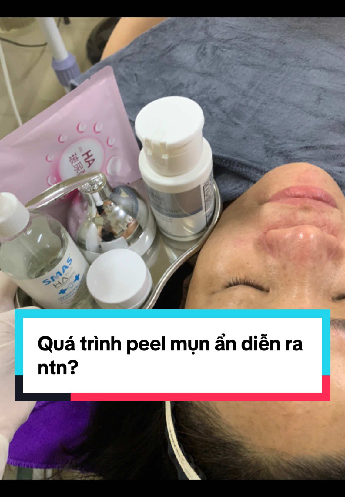 Combo peel mụn ẩn & sáng da mờ thâm cho da dầy sừng, lcl, da ko đều màu