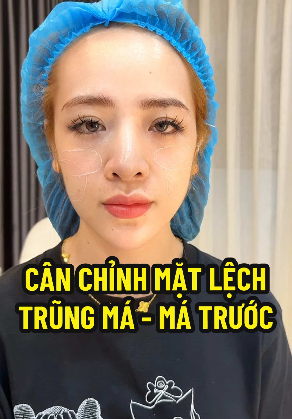 Thay đổi cho em gái khi tiêm làm đầy má trước và trũng má #nganfiller #ilovetiktok #xuhuong #fillerhanoi 
