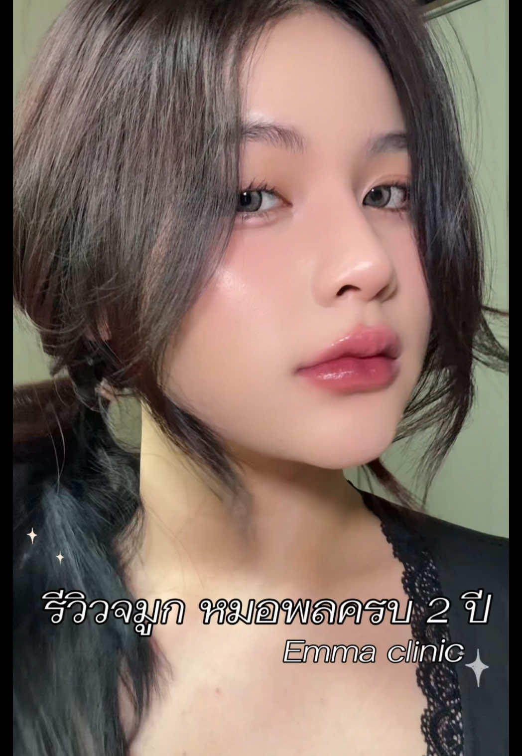 #emmaclinic #ลูกสาวเอมม่า #ลูกสาวหมอพล #เสริมจมูก #บอกต่อลูกสาวเอมม่า  #เอมม่าคลินิก #รีวิวเสริมจมูก #รีวิวศัลยกรรม  #เสริมจมูกที่ไหนดี @Emma Clinic Thailand 