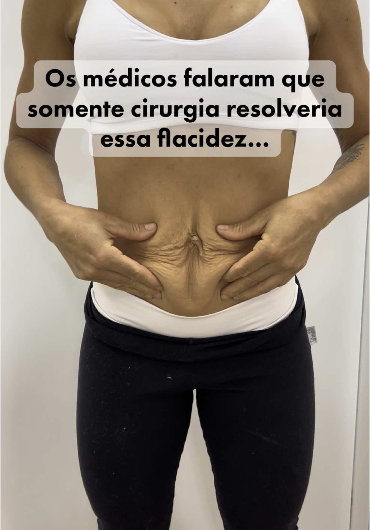 Mais uma paciente que não precisou de submeter as riscos da cirurgia e nem investir todo valor alto que é passar pelo bloco cirúrgico !   Sem contar que não precisou ficar de repouso 😍🙌🏻🥰  #flacidez #lipohd #abdominoplastia #endolaser #lipolaser #barriganegativa #shape 