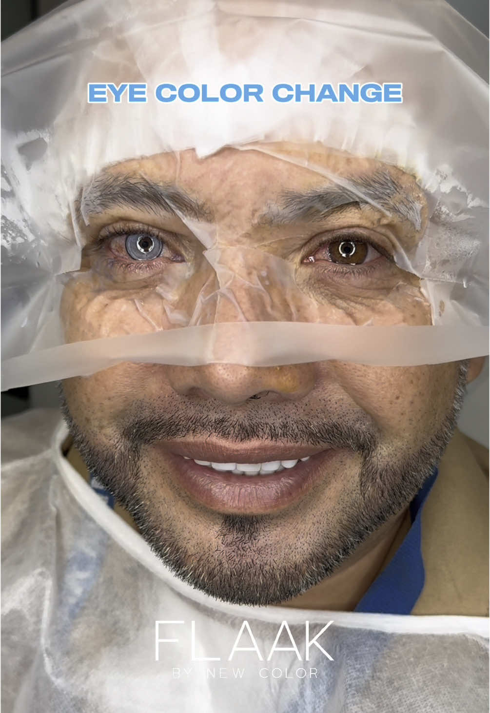 Eye color change using the FLAAK Pro technique, the most advanced and natural keratopigmentation ☝🏼  On the advice of FLAAK (by New Color), he chose the Azure color at the New Vision clinic in Nice🇫🇷 Operated by Dr Renato De Natale  You dream about changing the color of your eyes ? Send us a PM 💌 #newcolor #flaak #keratopigmentation #visumax #visumax800 #eye #eyecolorchange  ##קרטופיגמנטציה#ceratopigmentação #تصبغ القرنية #cheratopigmentazione  