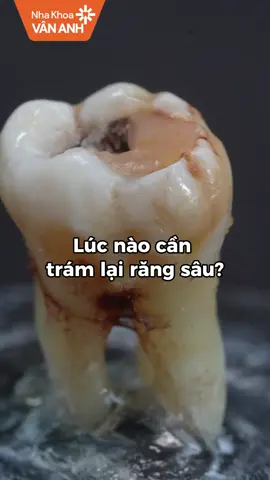 Lúc nào cần trám lại răng sâu? Đây là 3 dấu hiệu nhận biết! #nhakhoa #nhakhoavananh #saurang #hoimieng #xuhuong #fypシ゚ #hanoi 