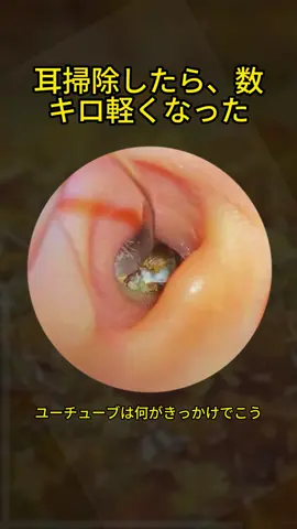 #耳垢ナカショー #耳垢掃除 #耳掃除 #earwax 
