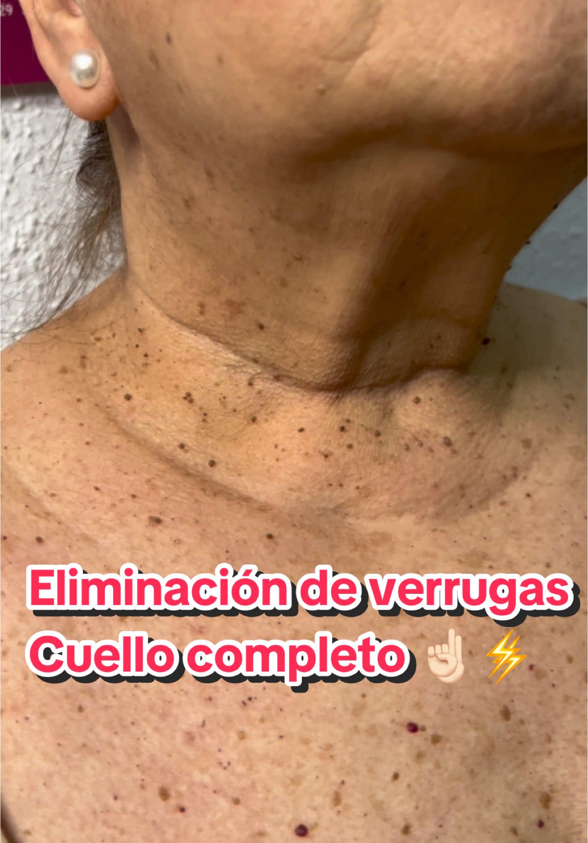 ELIMINACIÓN DE VERRUGAS⚡️ •Resultados de dos semanas 🗓️ y el cambio es increíble. •¿A qué esperáis en quitárosla? #adiosverrugas #eliminaciondeverrugas #verrugas #plasmapen #verano #malaga #paratiiiiiiiiiiiiiiiiiiiiiiiiiiiiiii #contactos #vira 
