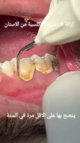 #dentist #alger #algerie🇩🇿 #الجزائر #zirconia #detartrage