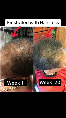 Hair loss can feel like an endless battle, but the Grow My Hair Extra Strength Hair Growth Oil, is formulated with ingredients like castor oil, fenugreek and rosemary. It helps promote hair growth, reduce shedding, and strengthen hair follicles. It’s time to fight back against hair loss—start today. Tap the cart to checkout. #scalpcare #haircare #scalphealth #healthyhair 