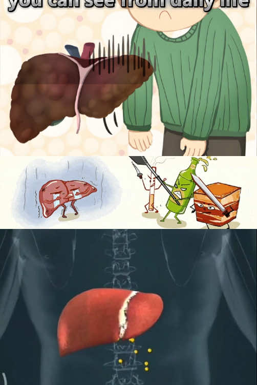 #symptoms #livercleanse #fattyliver #healthydiets #fyp #liverdetox #cirrhosis 