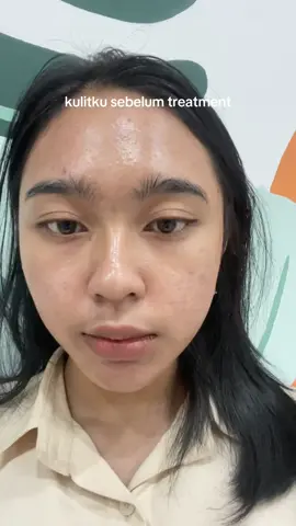 emang treatment yang paling bikin males tuh fase downtime babak belurnya 😩 #acne #acnefighter #acneproneskin #breakout #jerawat #acnetreatment #closedkomedo #treatment #ekstraksikomedo 
