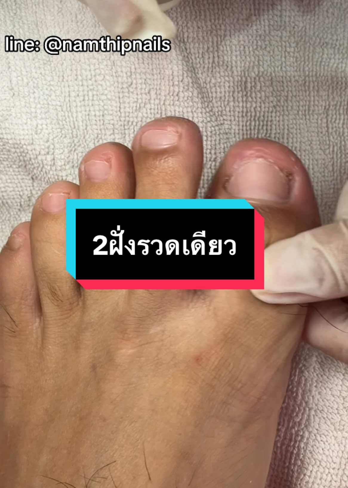 💓 #namthipnails #ตัดเล็บขบ #ตัดหนัง #ทำเล็บ #ร้านตัดเล็บขบ #ร้านตัดเล็บขบราม2 #ตัดเล็บ #เล็บขบ  #เล็บเชื้อรา Fb : namthipnails  Line : @namthipnails  นัมเบอร์วัน8 ตลาดม.ราม2  กทม  Map: namthipnails  https://goo.gl/maps/JmwpCKLfKwmhKGK96  ร้านเปิดทุกวัน เวลา12.00น-22.00น.