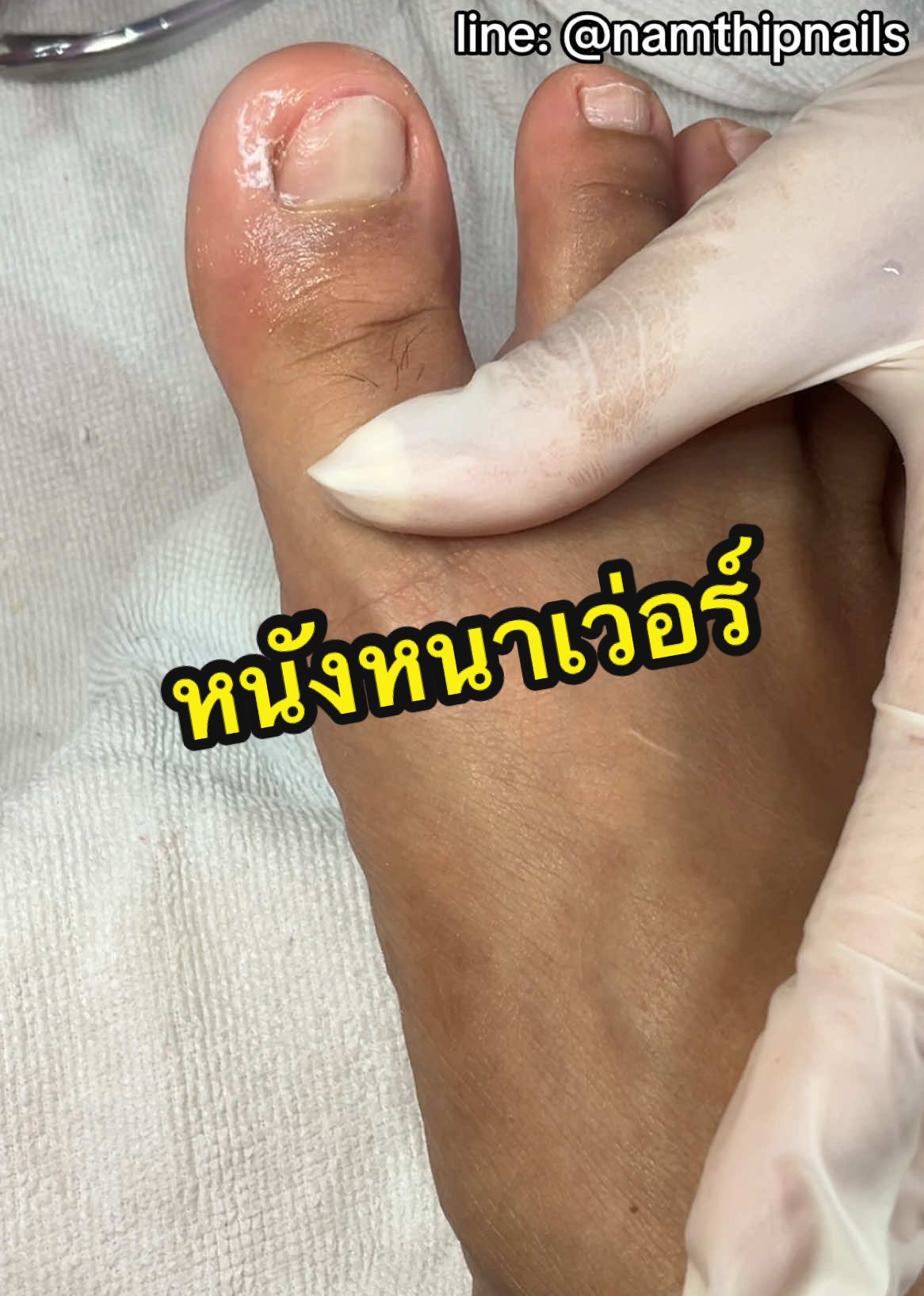 💓 #namthipnails #ตัดเล็บขบ #ตัดหนัง #ทำเล็บ #ร้านตัดเล็บขบ #ร้านตัดเล็บขบราม2 #ตัดเล็บ #เล็บขบ  #เล็บเชื้อรา Fb : namthipnails  Line : @namthipnails  นัมเบอร์วัน8 ตลาดม.ราม2  กทม  Map: namthipnails  https://goo.gl/maps/JmwpCKLfKwmhKGK96  ร้านเปิดทุกวัน เวลา12.00น-22.00น.