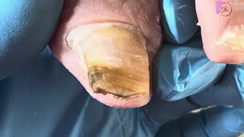 Thick Onychomycosis, Cut Off The Front Of The Bad Nail #pedicure #naildesigns #ingrownnail #nailtutorial #fungusnailstreatment #ingrowntoenail #nailart #nails #viraltiktok #nailsartvideos #fungusnails #fungus #viralvideo #viral #修脚 #trending #nailpolish #trend #toenail #nail #laykhoemongchan❤ #laykhoe #fyp #fypシ゚viral#fyppppppppppppppppppppppp