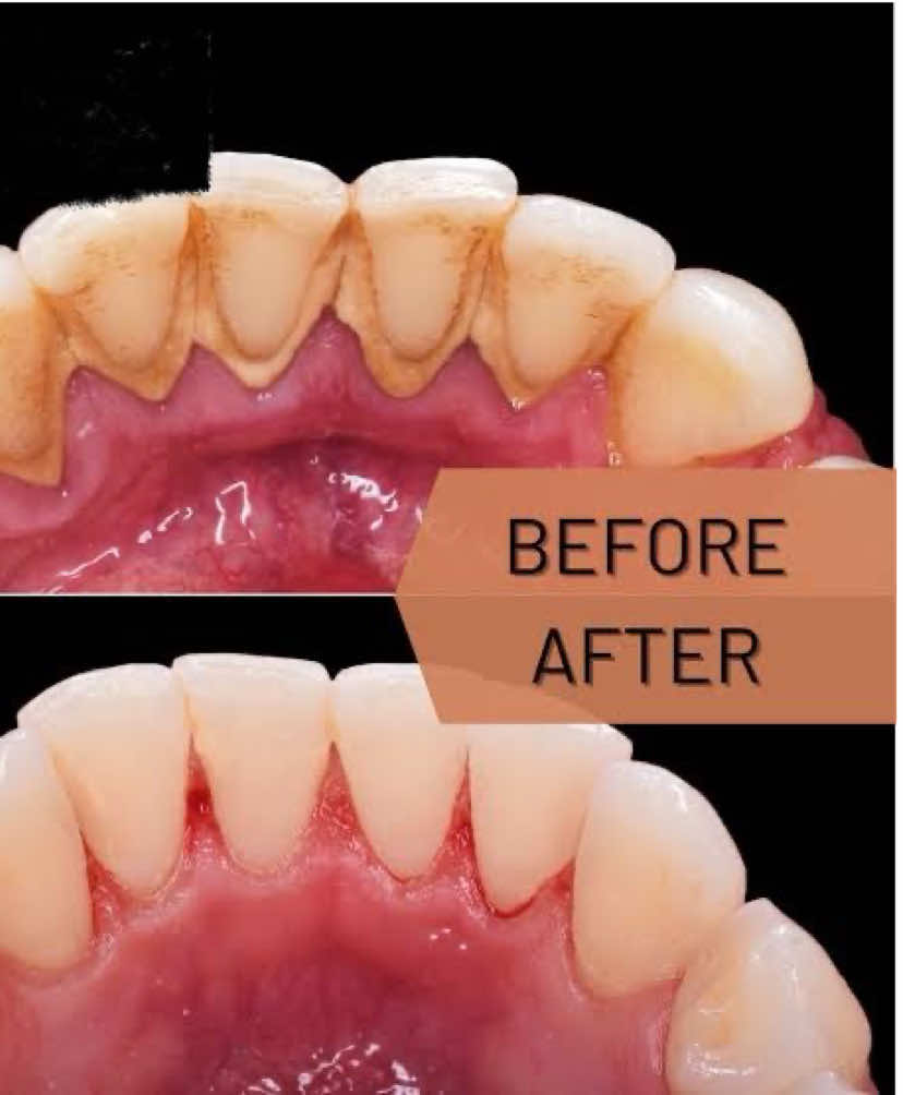 Ang mahal pa naman magpa linis ng ngipin.. #electricteethcleaner #tartarremover #teethcleaner #tartar 