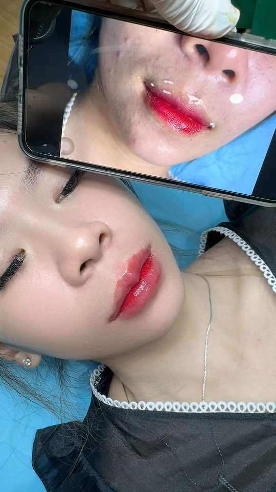 Cân chỉnh môi 