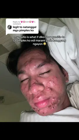 Replying to @💗💢ASH💢💗 grabe buti nalang talaga ginamit ko 😭😭😭 #acne #pimples #severacne #niacinamide #niacinamideserum #breakout #skincareroutine 