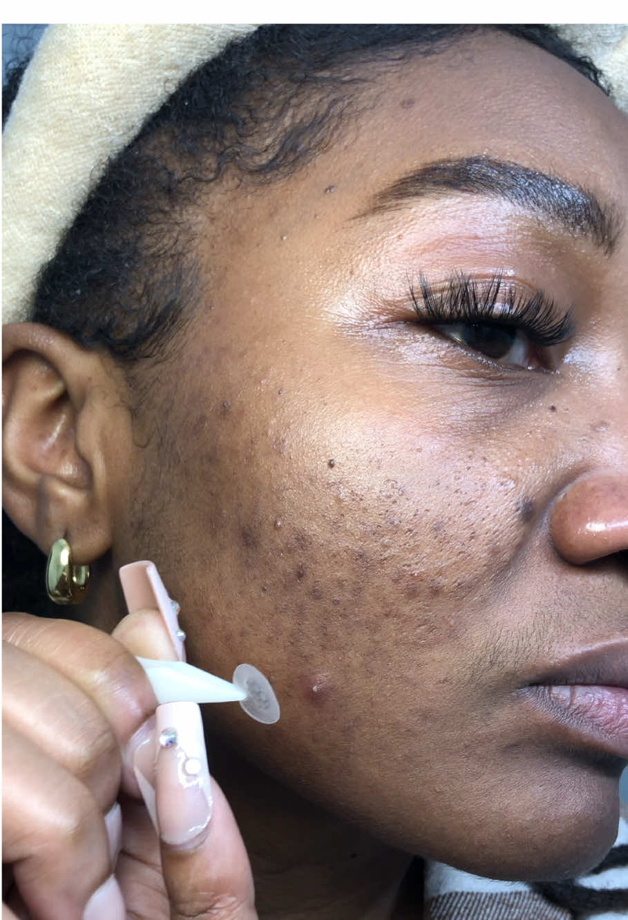 @Easyderm literally made my pimple disappear like magic with their microneedle pimple patch! Put the serum on the pimple patch, apply the pimple patch to the pimple, leave it on overnight and wala…pimple gone! 10/10! #pimplepatch #easyderm #koreanpimplepatches #microneedlepatch #acnepatches #pimplepatchremoval 