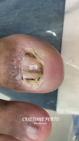 🤤| O VÍDEO MAIS SATISFATÓRIO DA SEMANA  . #podologia #fyp #satisfying #satisfatório #peeling #nails 
